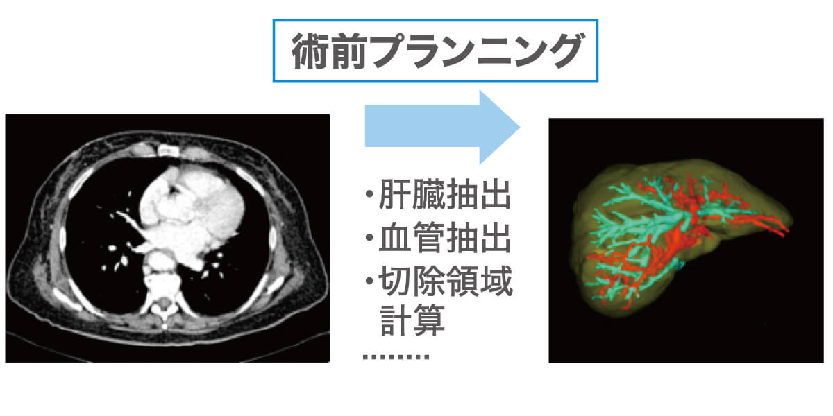 術前プランニング　図表